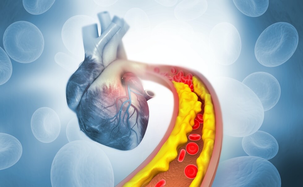 statin statin