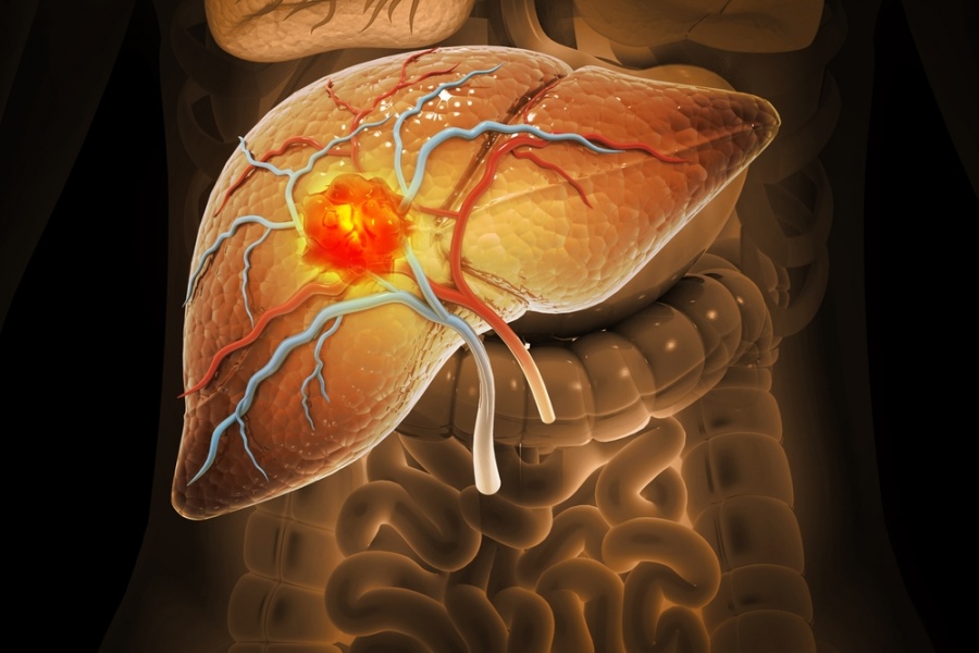 Karaciğerin en sık görülen tümörü : Hepatoselüler Karsinom - thumbnail