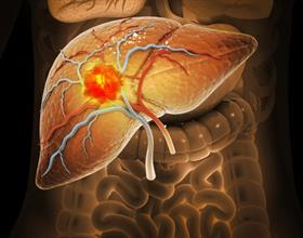 Karaciğerin en sık görülen tümörü : Hepatoselüler Karsinom - thumbnail